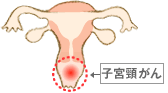 子宮頸がん