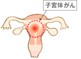子宮体がん
