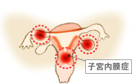 子宮内膜症