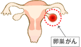卵巣がん